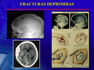 FRACTURAS DEPRIMIDAS 