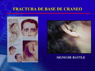 FRACTURA DE BASE DE CRANEO SIGNO DE BATTLE 