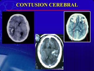CONTUSION CEREBRAL 