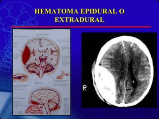 HEMATOMA EPIDURAL O EXTRADURAL 