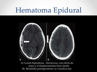 Hematoma Epidural
A) Lesión hiperdensa «biconvexa» con efecto de
masa y el desplazamiento línea media
B) Resultado postoperatorio, se visualiza aire
 