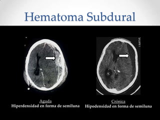 Hematoma Subdural
Aguda
Hiperdensidad en forma de semiluna
Crónica
Hipodensidad en forma de semiluna
 