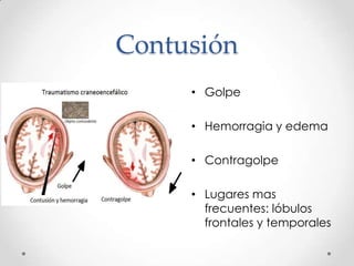 Contusión
• Golpe
• Hemorragia y edema
• Contragolpe
• Lugares mas
frecuentes: lóbulos
frontales y temporales
 