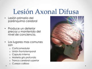 Lesión Axonal Difusa
• Lesión primaria del
parénquima cerebral
• Produce un deterior
precoz y mantenido del
nivel de conciencia.
• Los lugares mas comunes
son
o Corticomedular
o Unión frontotemporal
o Capsula interna
o Materia gris profunda
o Tronco cerebral superior
o Cuerpo calloso
 