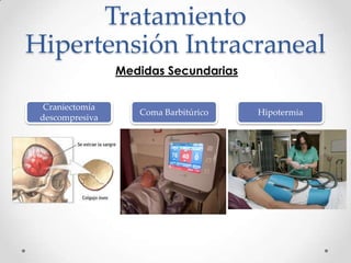 Tratamiento
Hipertensión Intracraneal
Medidas Secundarias
Craniectomía
descompresiva
Coma Barbitúrico Hipotermia
 