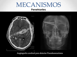 MECANISMOS
Penetrantes
Angiografía cerebral para detectar Pseudoaneurisma
 