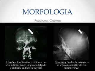 MORFOLOGIA
Fracturas Cráneo
Lineales: localización, rectilíneas, no
se ramifican, tienen un grosor delgado
y uniforme en todo su trayecto
Diastásica: bordes de la fractura
se separan coincidiendo con
sutura craneal
 