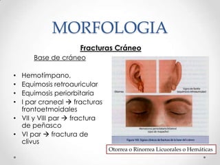 MORFOLOGIA
Fracturas Cráneo
Base de cráneo
• Hemotímpano,
• Equimosis retroauricular
• Equimosis periorbitaria
• I par craneal  fracturas
frontoetmoidales
• VII y VIII par  fractura
de peñasco
• VI par  fractura de
clivus
Otorrea o Rinorrea Licuorales o Hemáticas
 