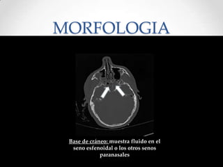 MORFOLOGIA
Fracturas Cráneo
Base de cráneo: muestra fluido en el
seno esfenoidal o los otros senos
paranasales
 