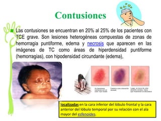 Contusiones
Las contusiones se encuentran en 20% al 25% de los pacientes con
TCE grave. Son lesiones heterogéneas compuestas de zonas de
hemorragia puntiforme, edema y necrosis que aparecen en las
imágenes de TC como áreas de hiperdensidad puntiforme
(hemorragias), con hipodensidad circundante (edema),




                     localizadas en la cara inferior del lóbulo frontal y la cara
                     anterior del lóbulo temporal por su relación con el ala
                     mayor del esfenoides.
 
