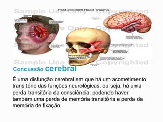 Concussão cerebral
É uma disfunção cerebral em que há um acometimento
transitório das funções neurológicas, ou seja, há uma
perda transitória da consciência, podendo haver
também uma perda de memória transitória e perda da
memória de fixação.
 