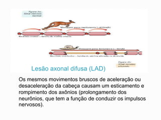 Lesão axonal difusa (LAD)
Os mesmos movimentos bruscos de aceleração ou
desaceleração da cabeça causam um esticamento e
rompimento dos axônios (prolongamento dos
neurônios, que tem a função de conduzir os impulsos
nervosos).
 