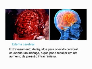 Edema cerebral
Extravasamento de líquidos para o tecido cerebral,
causando um inchaço, o que pode resultar em um
aumento da pressão intracraniana.
 