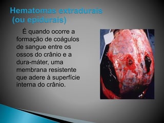 É quando ocorre a
formação de coágulos
de sangue entre os
ossos do crânio e a
dura-máter, uma
membrana resistente
que adere à superfície
interna do crânio.
 