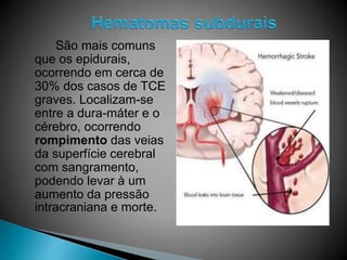 São mais comuns
que os epidurais,
ocorrendo em cerca de
30% dos casos de TCE
graves. Localizam-se
entre a dura-máter e o
cérebro, ocorrendo
rompimento das veias
da superfície cerebral
com sangramento,
podendo levar à um
aumento da pressão
intracraniana e morte.
 