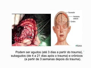 .
Podem ser agudos (até 3 dias a partir do trauma),
subagudos (de 4 a 21 dias após o trauma) e crônicos
(a partir de 3 semanas depois do trauma).
 