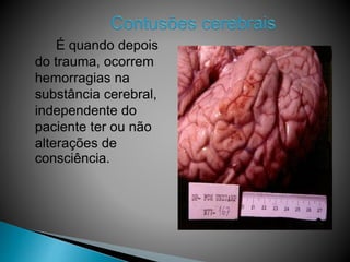 É quando depois
do trauma, ocorrem
hemorragias na
substância cerebral,
independente do
paciente ter ou não
alterações de
consciência.
 