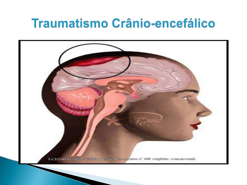 Traumatismo Cranio Encefalico Cid - RETOEDU