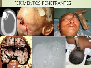 FERIMENTOS PENETRANTES
 