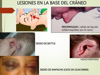 LESIONES EN LA BASE DEL CRÁNEO
SIGNO DE BATTLE
SIGNO DE MAPACHE (OJOS DE GUACHININ)
RINORRAQUIA ( salida de líquido
cefalorraquídeo por la nariz)
HEMOTIMPANO
 