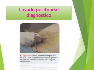 Lavado peritoneal
diagnostico

 