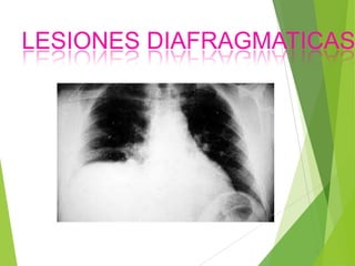 LESIONES DIAFRAGMATICAS

 