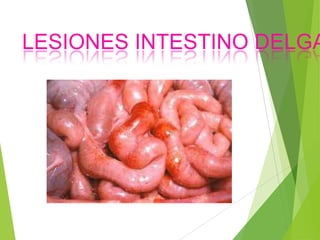 LESIONES INTESTINO DELGA

 