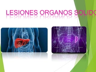 LESIONES ORGANOS SOLIDO

 