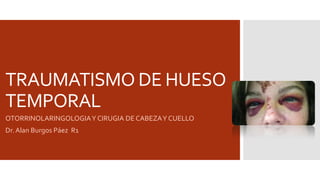 TRAUMATISMO DE HUESO
TEMPORAL
OTORRINOLARINGOLOGIA Y CIRUGIA DE CABEZA Y CUELLO
Dr. Alan Burgos Páez R1

 