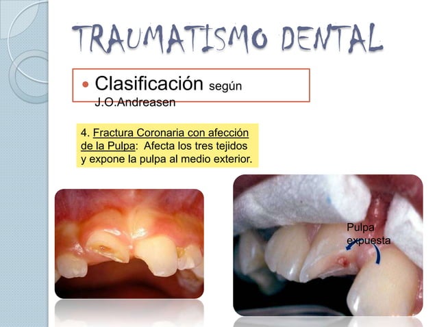 Traumatismo dental