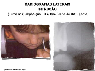 RADIOGRAFIAS LATERAIS
                           INTRUSÃO
   (Filme nº 2, exposição – 8 a 10s., Cone de RX – ponta




(KR...