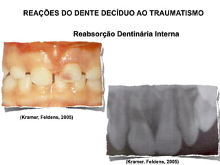 REAÇÕES DO DENTE DECÍDUO AO TRAUMATISMO

                          Reabsorção Dentinária Interna




(Kramer, Feldens, 200...