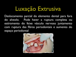 Luxação Extrusiva
Deslocamento parcial do elemento dental para fora
do alveolo. Pode haver a ruptura completa ou
estiramen...