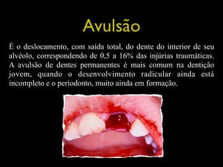 Avulsão
É o deslocamento, com saída total, do dente do interior de seu
alvéolo, correspondendo de 0,5 a 16% das injúrias t...