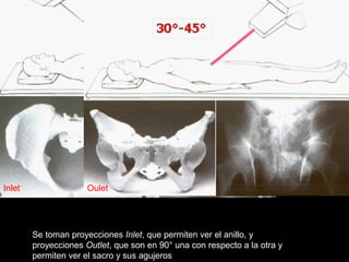Se toman proyecciones Inlet, que permiten ver el anillo, y
proyecciones Outlet, que son en 90° una con respecto a la otra y
permiten ver el sacro y sus agujeros
Inlet Oulet
 