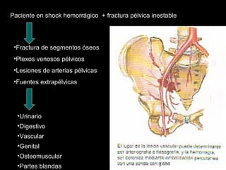 Paciente en shock hemorrágico + fractura pélvica inestable
•Fractura de segmentos óseos
•Plexos venosos pélvicos
•Lesiones de arterias pélvicas
•Fuentes extrapélvicas
•Urinario
•Digestivo
•Vascular
•Genital
•Osteomuscular
•Partes blandas
 