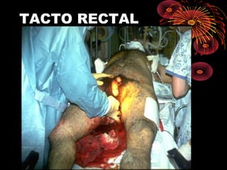 TACTO RECTAL
 