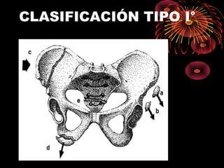 CLASIFICACIÓN TIPO I°
 