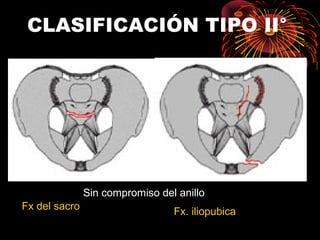 CLASIFICACIÓN TIPO II°
Fx del sacro
Fx. iliopubica
Sin compromiso del anillo
 