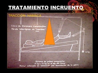 TRATAMIENTO INCRUENTO
TRACCIÓN- HAMACA
 