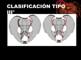 CLASIFICACIÓN TIPO
III°
 