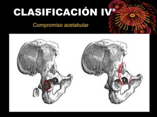 CLASIFICACIÓN IV°
Compromiso acetabular
 