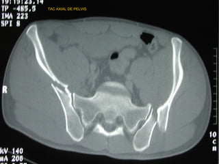 TAC AXIAL DE PELVIS
 