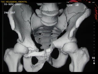 TAC HELICOIDAL FRONTAL
 
