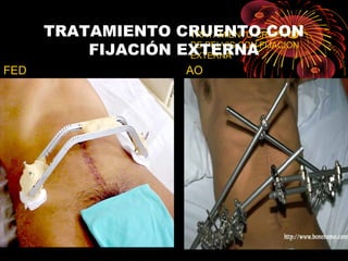 TRATAMIENTO CRUENTO
DE PELVIS CON FIJACION
EXTERNA
TRATAMIENTO CRUENTO CON
FIJACIÓN EXTERNA
FED AO
 