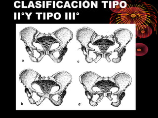 CLASIFICACIÓN TIPO
II°Y TIPO III°
 