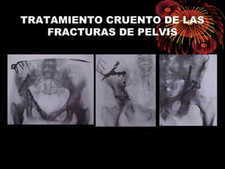TRATAMIENTO CRUENTO DE LAS
FRACTURAS DE PELVIS
 