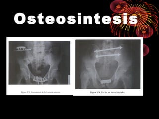 Osteosintesis
 