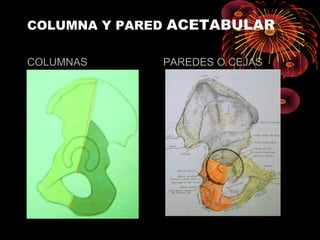 COLUMNA Y PARED ACETABULAR
COLUMNAS PAREDES O CEJAS
 