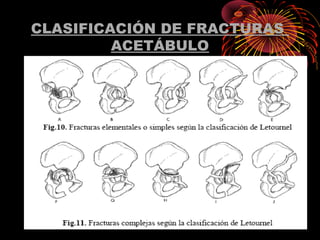 CLASIFICACIÓN DE FRACTURAS
ACETÁBULO
 